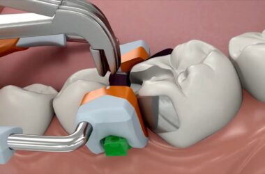 3D-Fusion-Teilmatrizensystem-Garrison-Dental-Solutions-Anwendung-Animationsvideo-Zahnmedizin