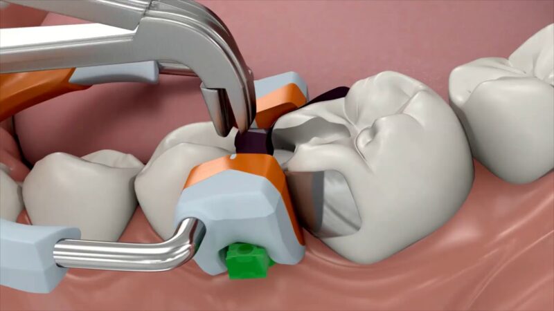 3D-Fusion-Teilmatrizensystem-Garrison-Dental-Solutions-Anwendung-Animationsvideo-Zahnmedizin