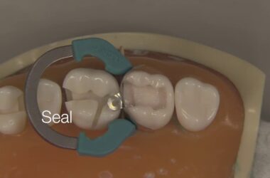 Class-II-Composite-Restoration-Stevenson-Dental-Solutions