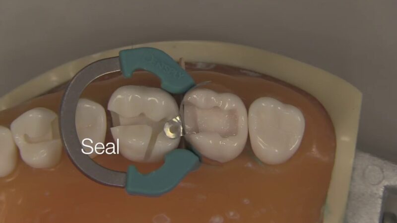 Class-II-Composite-Restoration-Stevenson-Dental-Solutions