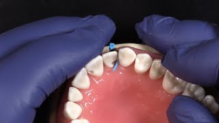 NEW-Fusion-Anterior-Matrix-System-from-Garrison-Dental-Solutions