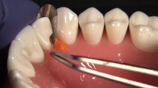 Tips-for-Using-the-NEW-Fusion-Anterior-Matrix-System-for-Deep-Restorations-with-Dr.-JD-Corey