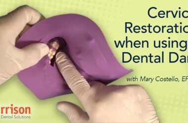 Cervical-Restoration-When-Using-a-Dental-Dam-Mary-Costello-EFDA