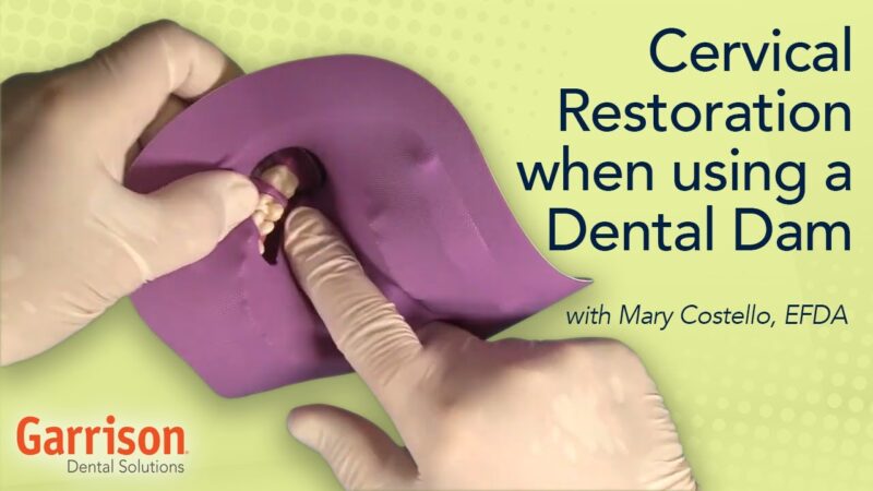 Cervical-Restoration-When-Using-a-Dental-Dam-Mary-Costello-EFDA