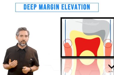 Deep-Margin-Elevation-DME-Technique-and-Kit-Introduction