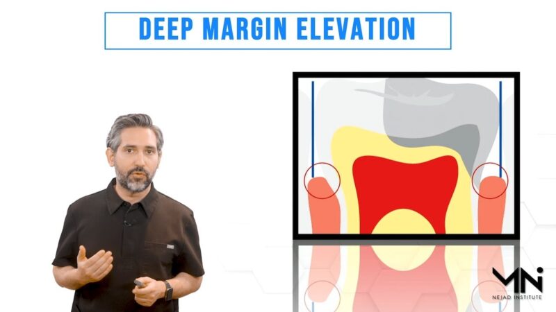 Deep-Margin-Elevation-DME-Technique-and-Kit-Introduction