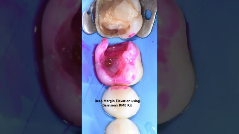 Deep-Margin-Elevation-using-Garrisons-DME-Kit