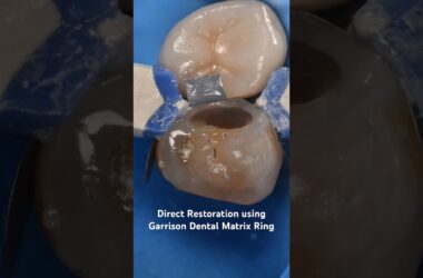 Direct-Restoration-using-Garrison-Dental-Matrix-Ring