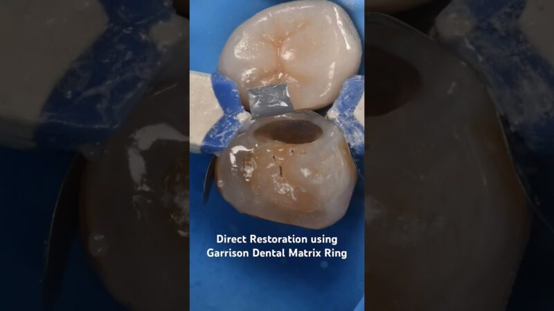 Direct-Restoration-using-Garrison-Dental-Matrix-Ring