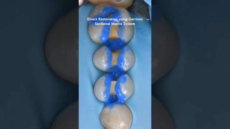 Direct-Restoration-using-Garrison-Sectional-Matrix-System