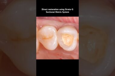 Direct-Restoration-using-Strata-G-Sectional-Matrix-System