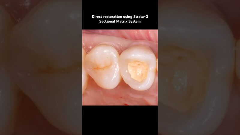 Direct-Restoration-using-Strata-G-Sectional-Matrix-System