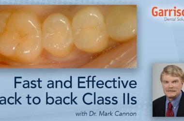 Fast-and-effective-back-to-back-Class-IIs-Featuring-Dr.-Mark-Cannon