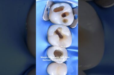 Margin-lifting-with-DME-from-Garrison-Dental-Solutions