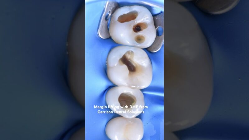 Margin-lifting-with-DME-from-Garrison-Dental-Solutions