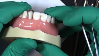 Placing-two-fusion-anterior-matrix-bands-on-a-single-tooth