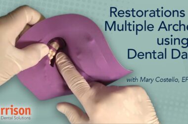 Restorations-in-Multiple-Arches-Using-a-Dental-Dam-Mary-Costello-EFDA