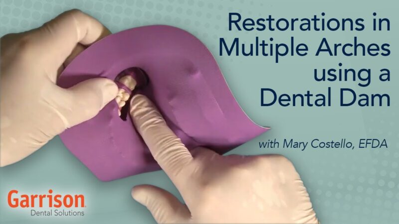 Restorations-in-Multiple-Arches-Using-a-Dental-Dam-Mary-Costello-EFDA