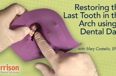 Restoring-the-Last-Tooth-in-the-Arch-Using-a-Dental-Dam-Mary-Costello-EFDA