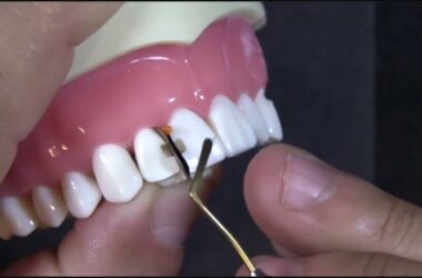 Setting-Your-Line-Angle-for-Anterior-Restorations-using-the-Fusion-Anterior-Matrix-System