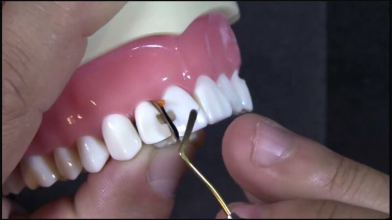 Setting-Your-Line-Angle-for-Anterior-Restorations-using-the-Fusion-Anterior-Matrix-System