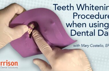 Teeth-Whitening-Procedures-When-Using-a-Dental-Dam-Mary-Costello-EFDA