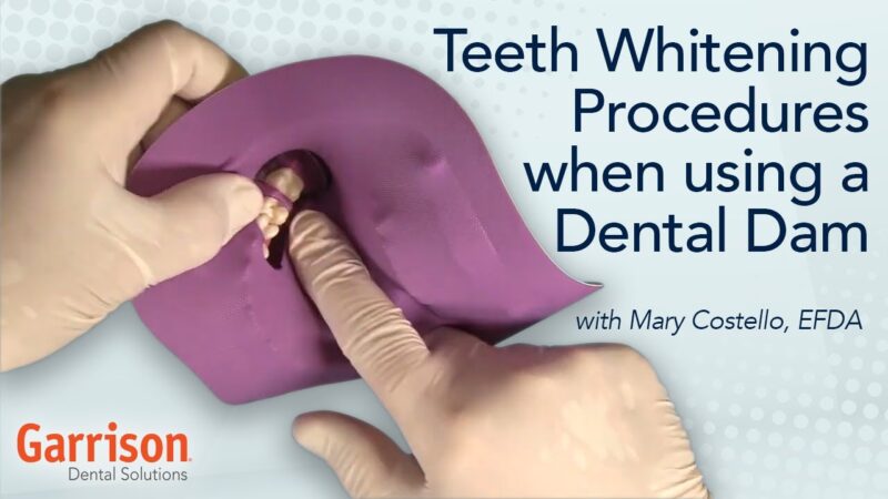 Teeth-Whitening-Procedures-When-Using-a-Dental-Dam-Mary-Costello-EFDA