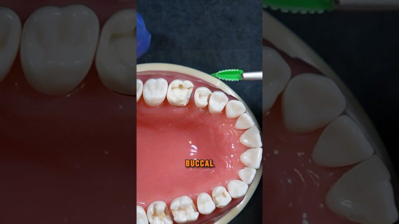 Which-direction-to-wedge-from-Buccal-or-Lingual