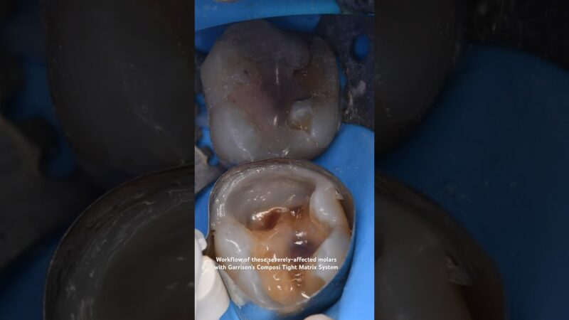 Workflow-of-these-severely-affected-molars-with-Garrisons-Composi-Tight-Matrix-System